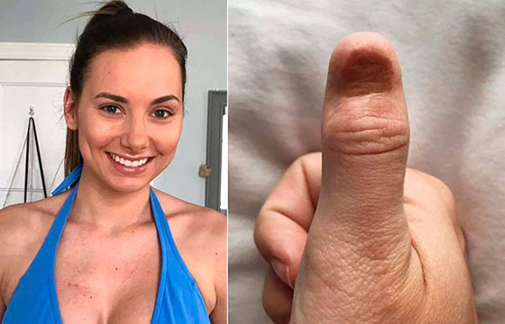Jovem modelo descobre câncer raro e médicos culpam técnica de unha em gel